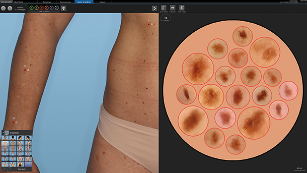 Locate lesions with DermaGraphix