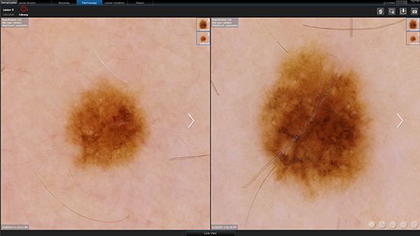 Lesion changes being monitored within DermaGraphix