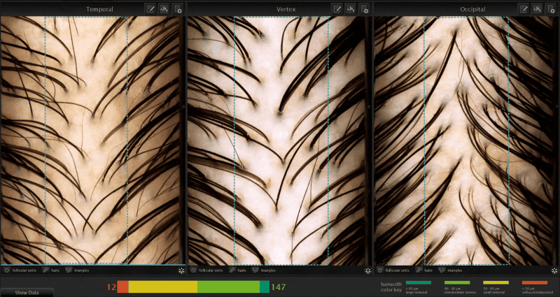 HairMetrix Analysis