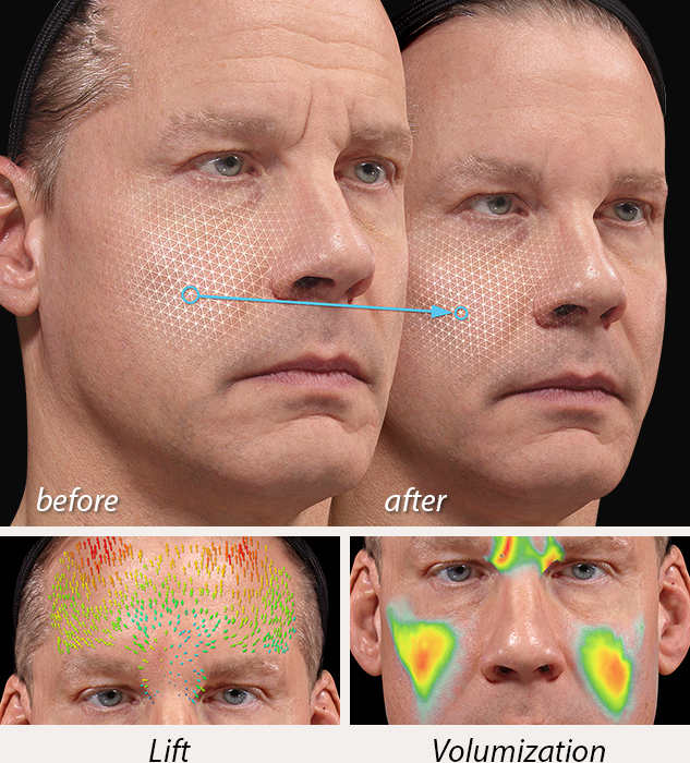 Canfields VECTRA 3D Markerless tracking technology for reviewing skin surface changes