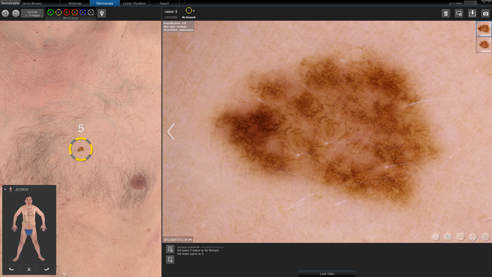 Lesions are tagged and searched on a patient's 3D capture by VECTRA WB360