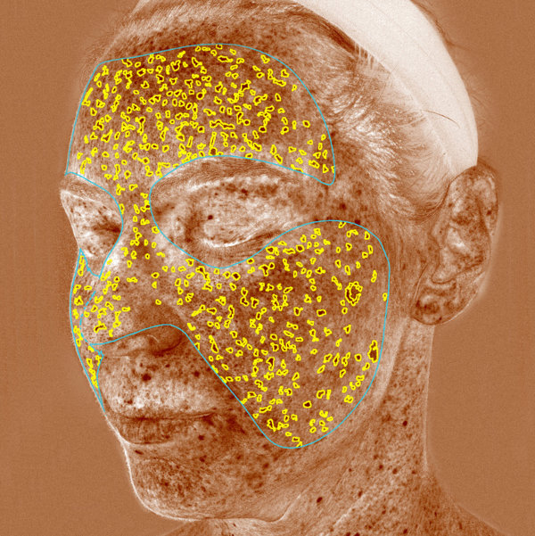 Advanced Skin Analysis - Brown Spots