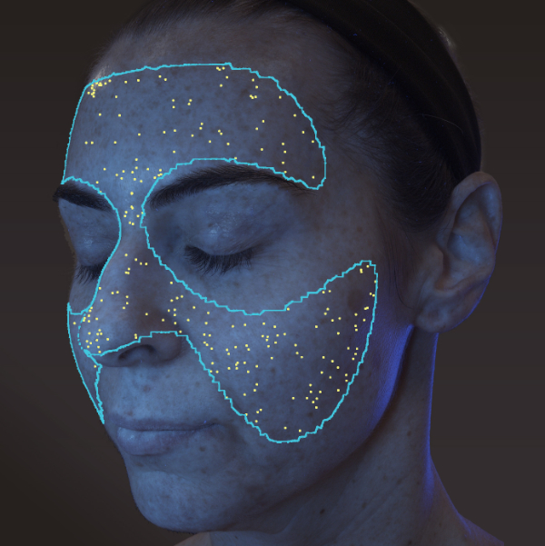 Advanced Skin Analysis - Porphyrins