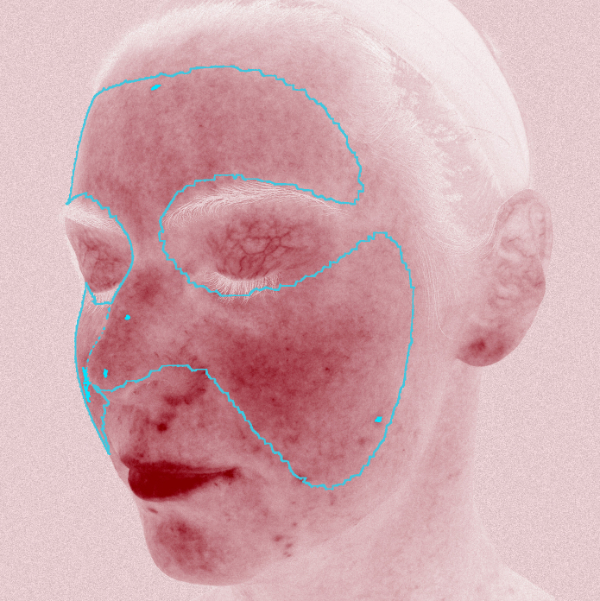 Advanced Skin Analysis - Red Areas