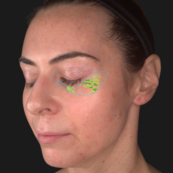 Advanced Skin Analysis - Wrinkles
